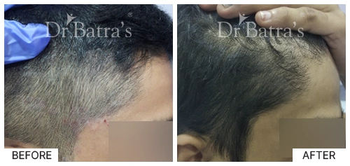 Hair Falling Treatment